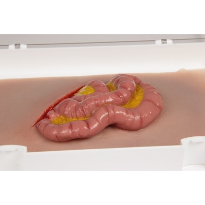 Erler Zimmer Wound Moulage Protruding Small Intestines